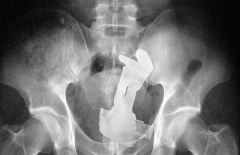 Vers l'infini et au delà !