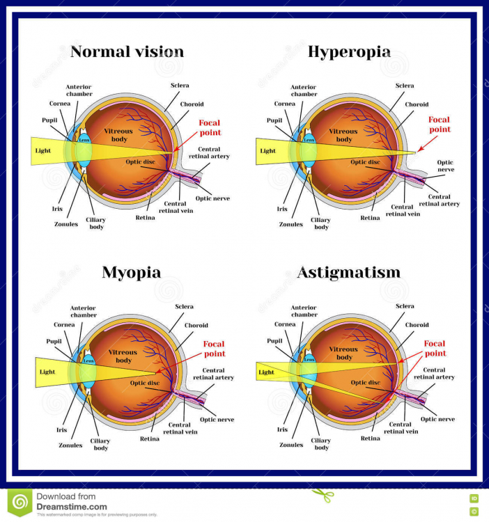 refractive-errors-eyeball-hyperopia-myopia-astigmatism-80086427.thumb.jpg.474ba20172d8e21d6e59a177e5e3cbe1.jpg