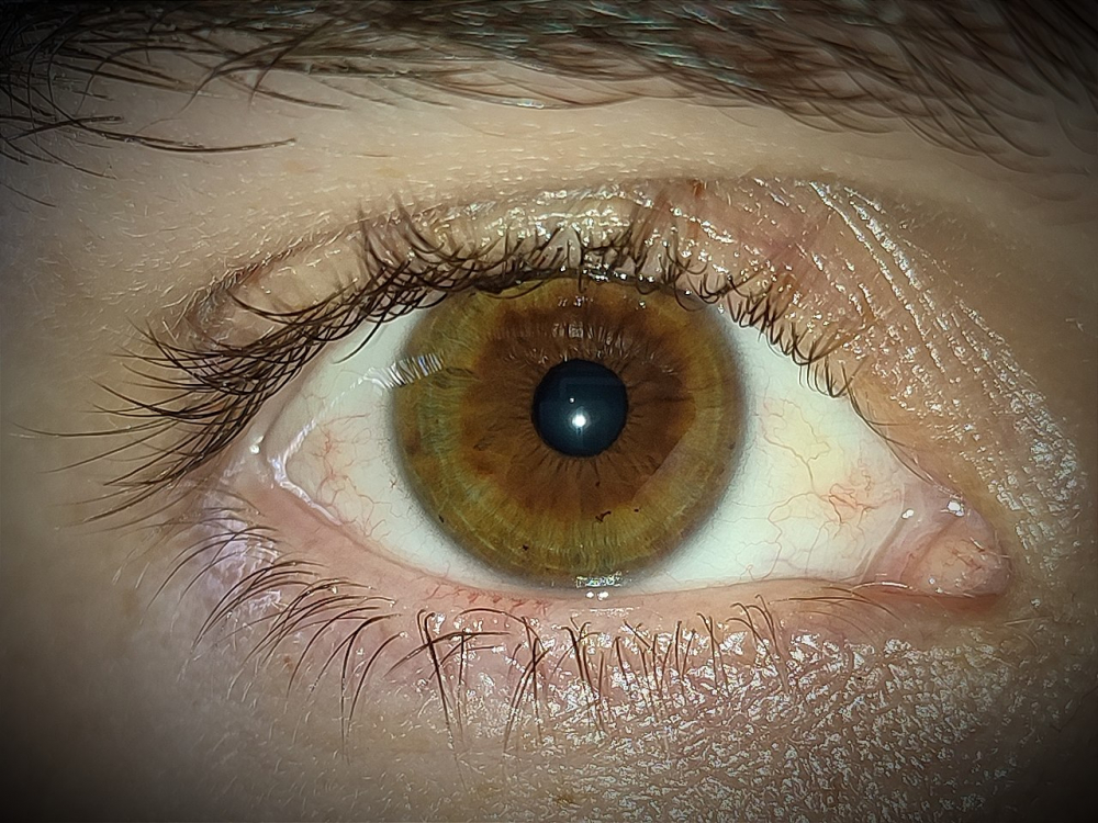 Pronounced_Central_Heterochromia_-_Human_Eye.jpg