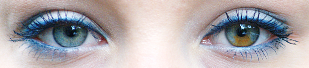 Segmental_heterochromia_in_left_eye.thumb.png.581ae092f18451ca4f1ca274c55adb1b.png